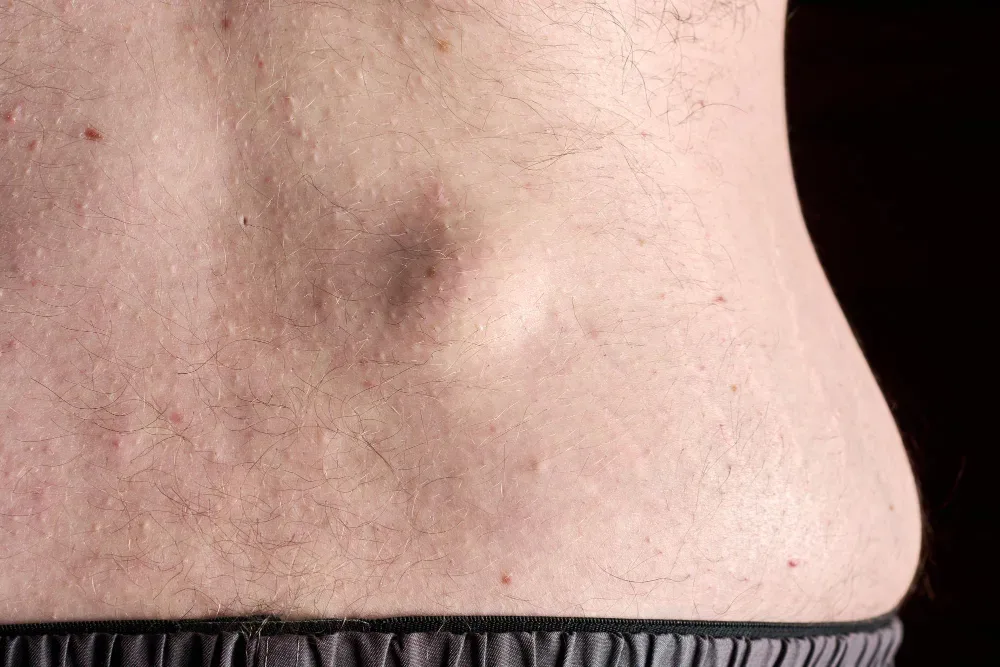 Cirugía de lipoma